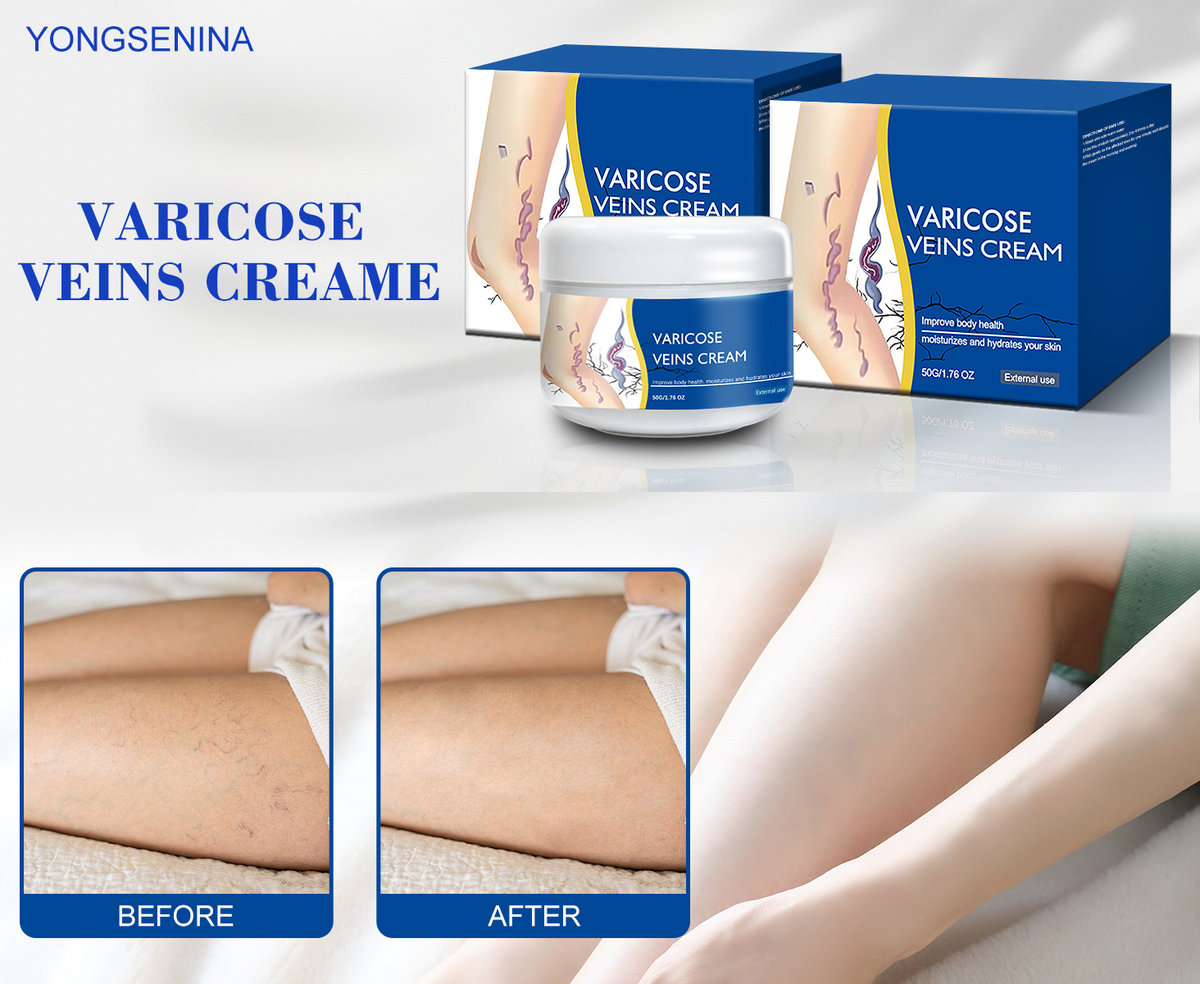 šBuy One Get One Freeš -AlcurasĀ® FastāAbsorbing Varicose Veins Care Cream For Smooth, Light, Confident Legsš¦µ