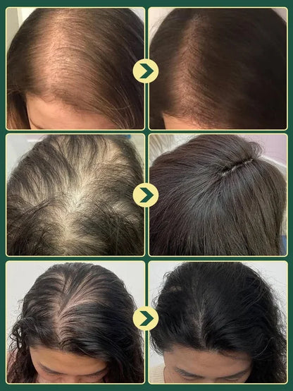 Limited Time🌿Unlock Better Hair with 70% OFF🔥Organic Rosemary Hair Growth Shampoo ⚡⚡  [The less hair, the better the effect]