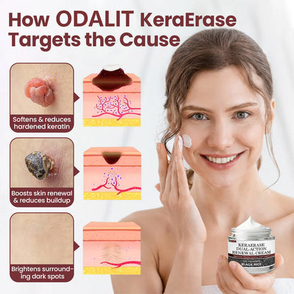 ✅Flash Sale -HEALRIZE®  KeraErase Dual-Action Renewal Cream